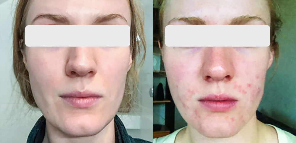 قبل و بعد پاکسازی پوست صورت