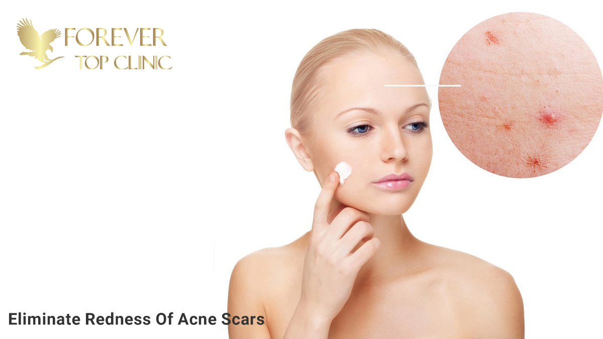 از بین بردن قرمزی جای جوش