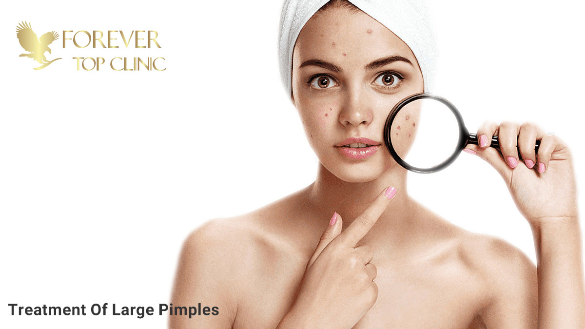 درمان جوش های بزرگ