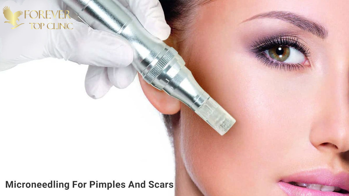 میکرونیدلینگ جای جوش و اسکار صورت