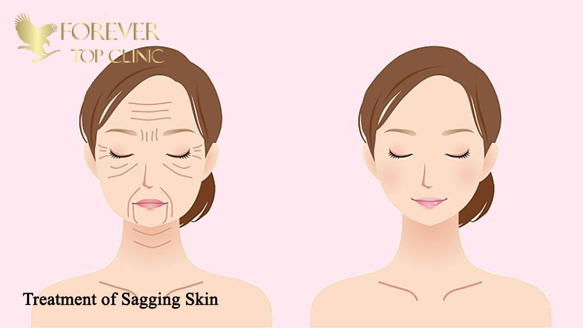 درمان شلی و افتادگی پوست