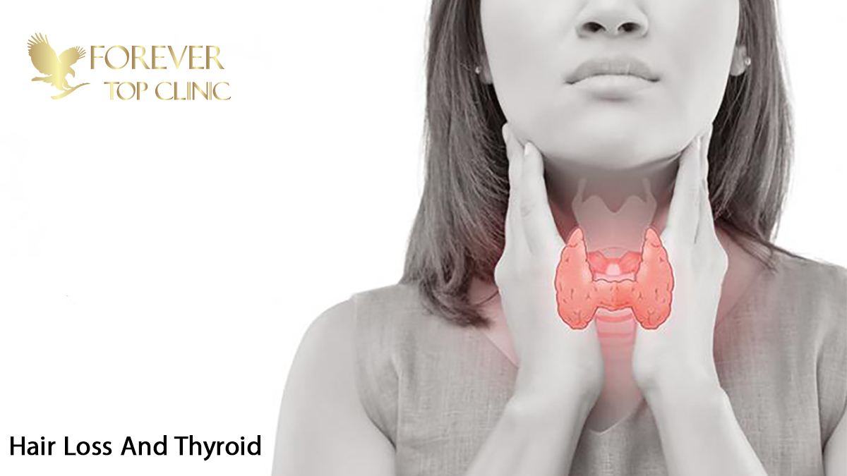 ریزش مو و تیروئید