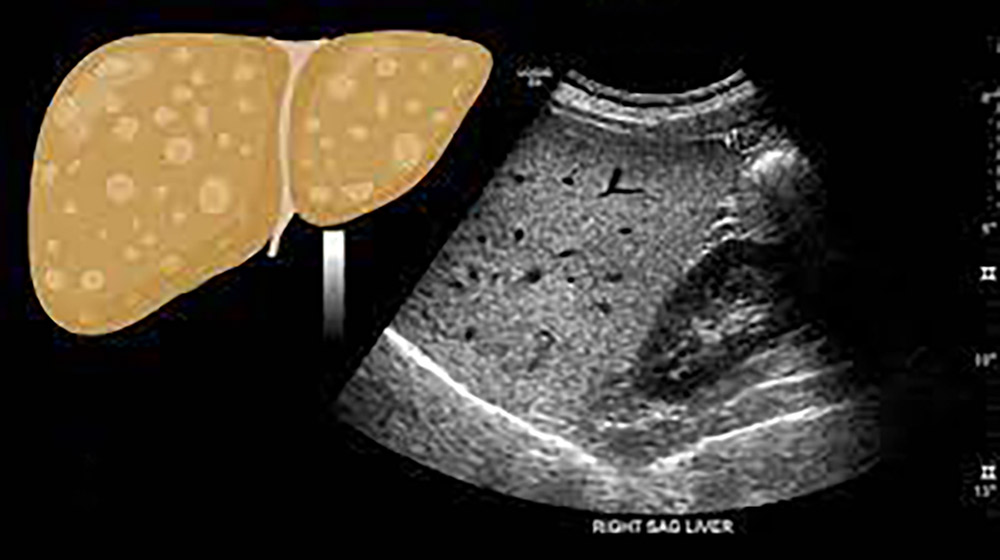 تشخیص کبد چرب با سونوگرافی