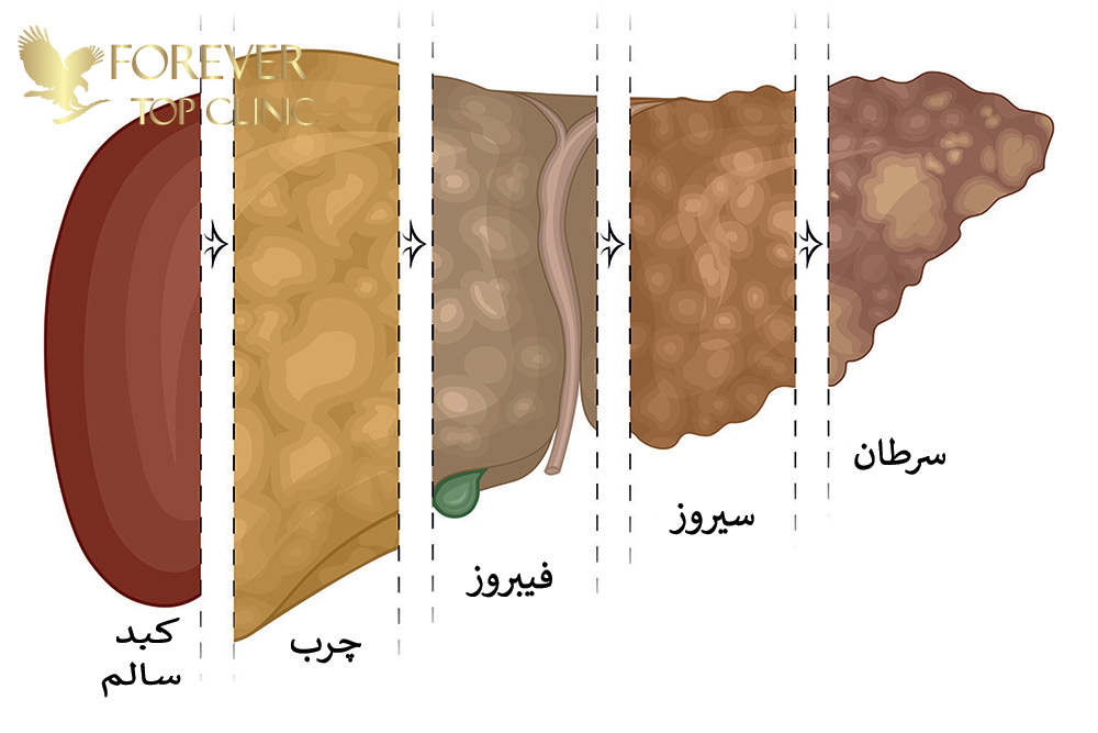 گریدهای کبد چرب