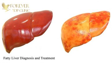 کبد چرب درمان و تشخیص
